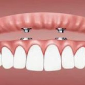 Denture_Clip_ons.JPG