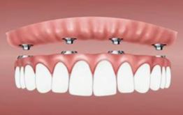 Denture_Clip_ons.JPG